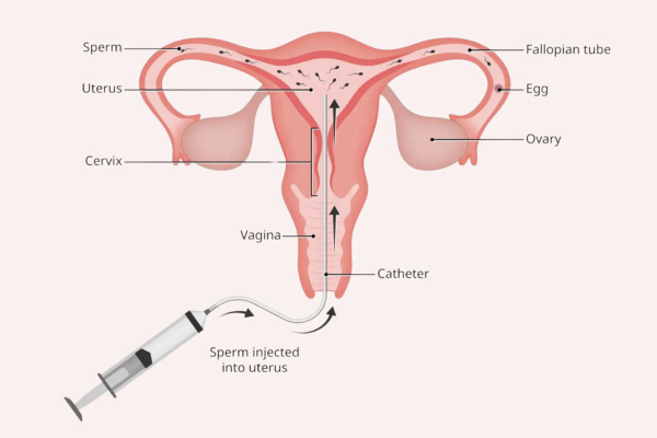 IUI Treatment in Mumbai